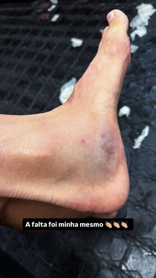 Gustavo Henrique exibe inflamação no pé após jogo contra o Santos